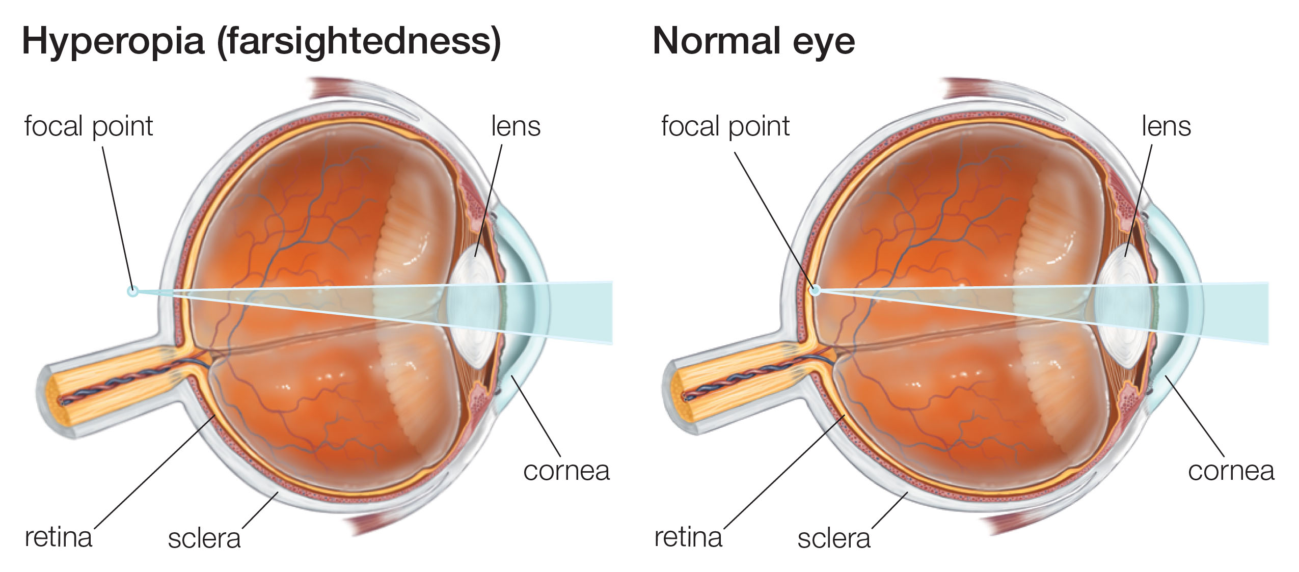 betegség myopia 2 hyperopia)