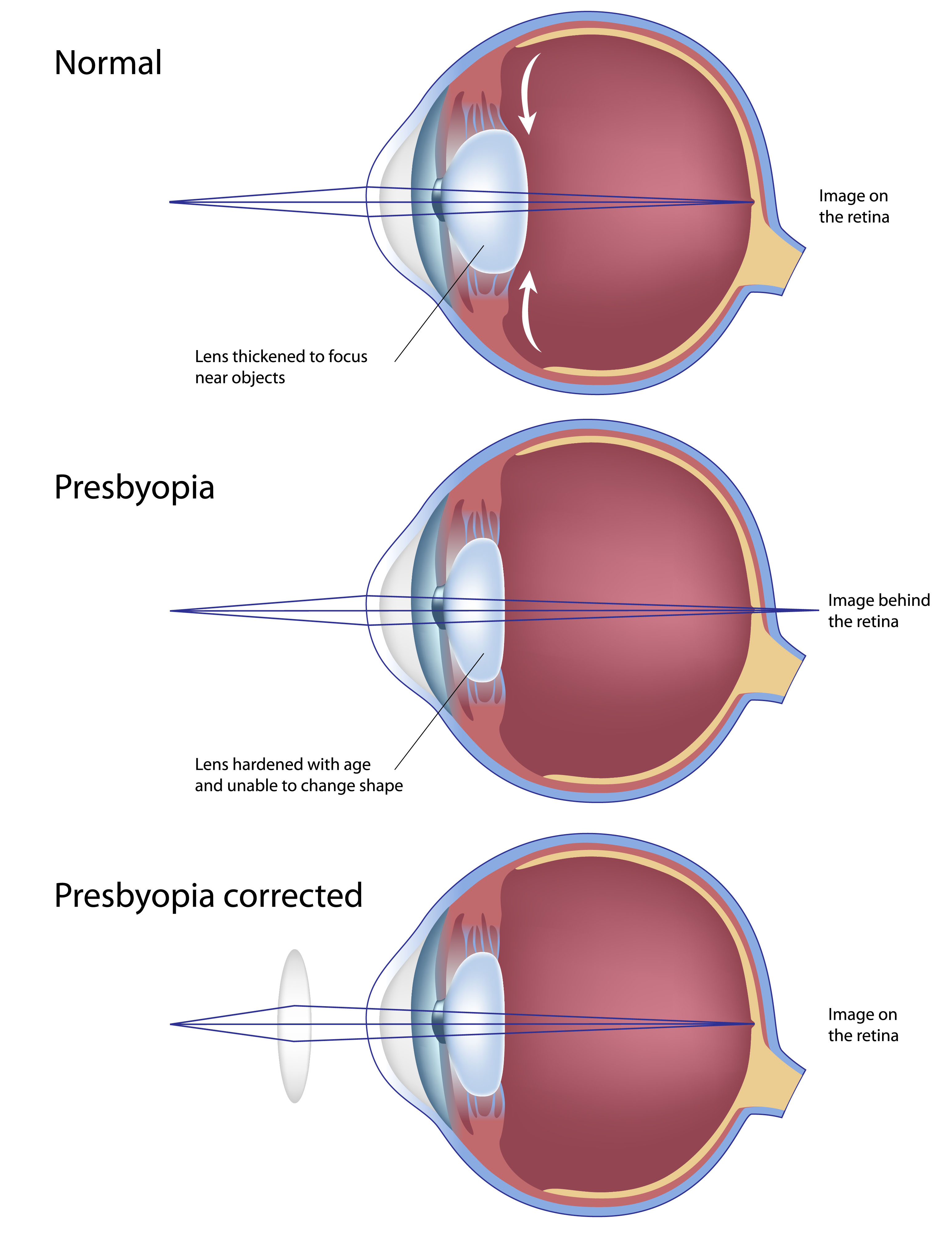 myopia és presbyopia